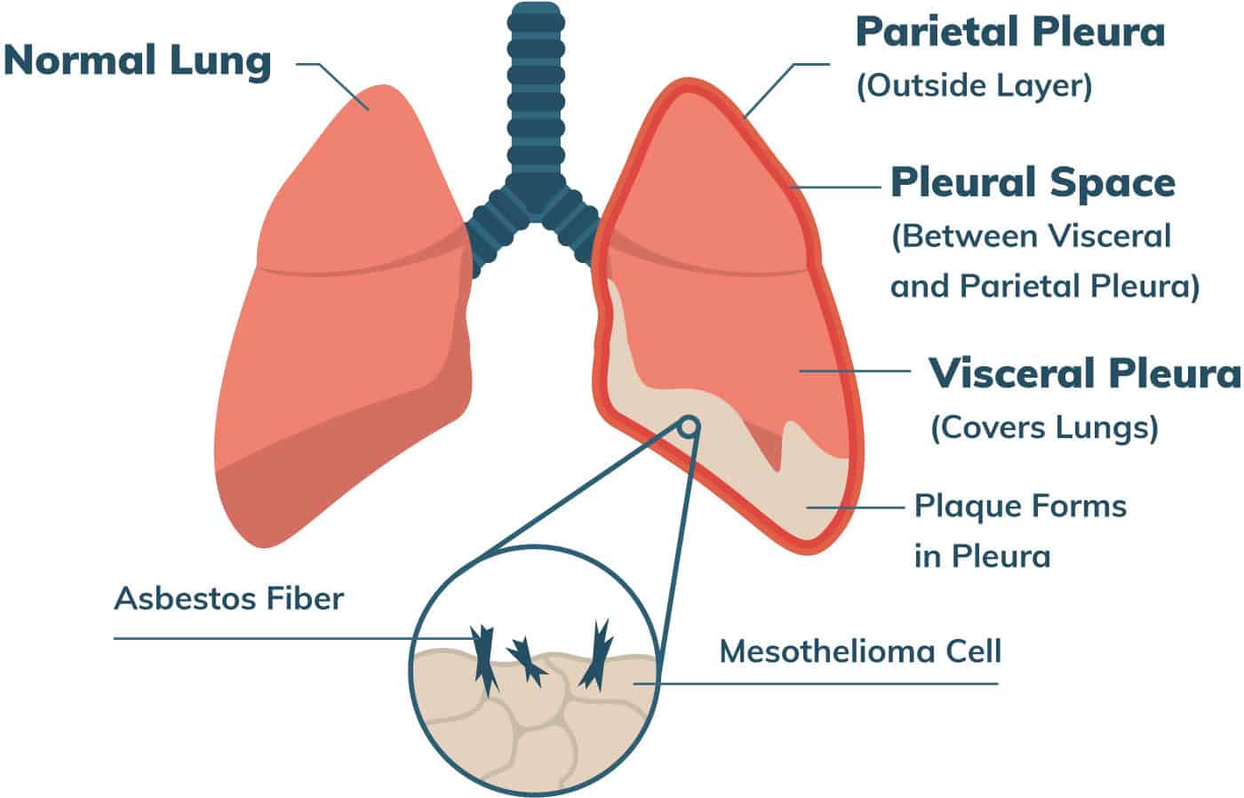 mesothelioma