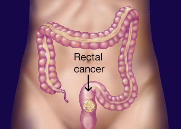 rectal-cancer