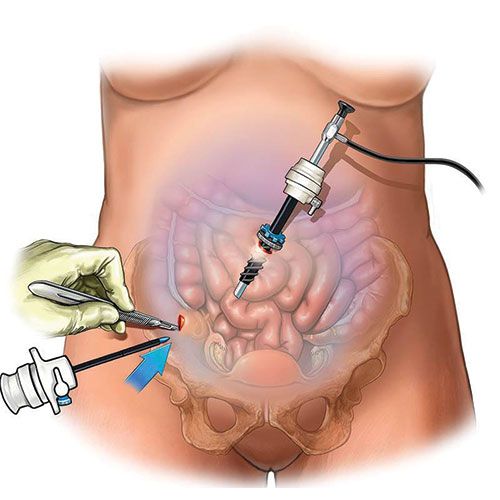 laparoscopic-cancer-surgery.jpg